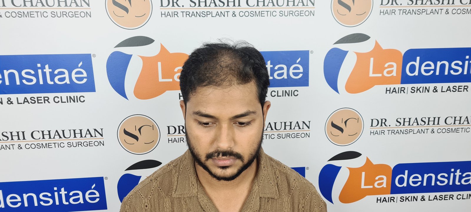 Azher Before Hair Transplant