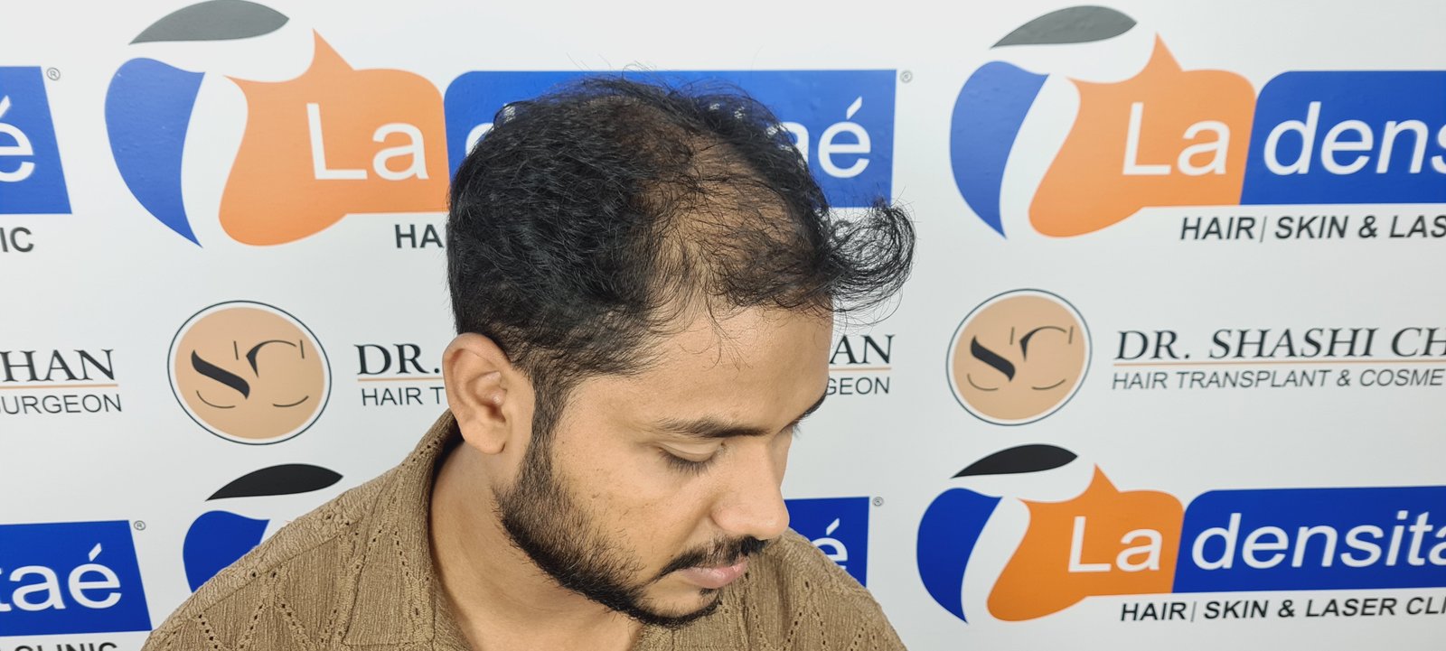 Azher Before Hair Transplant