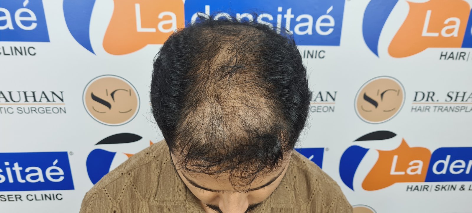 Azher Before Hair Transplant
