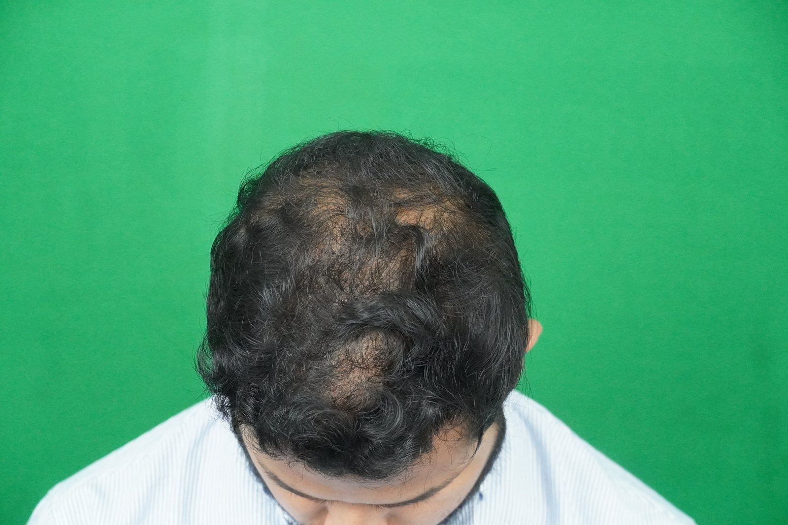 Azher After Hair Transplant