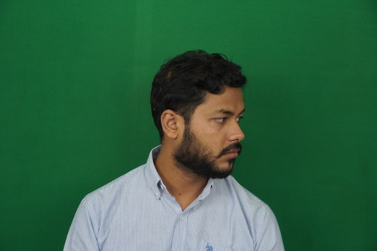 Azher After Hair Transplant