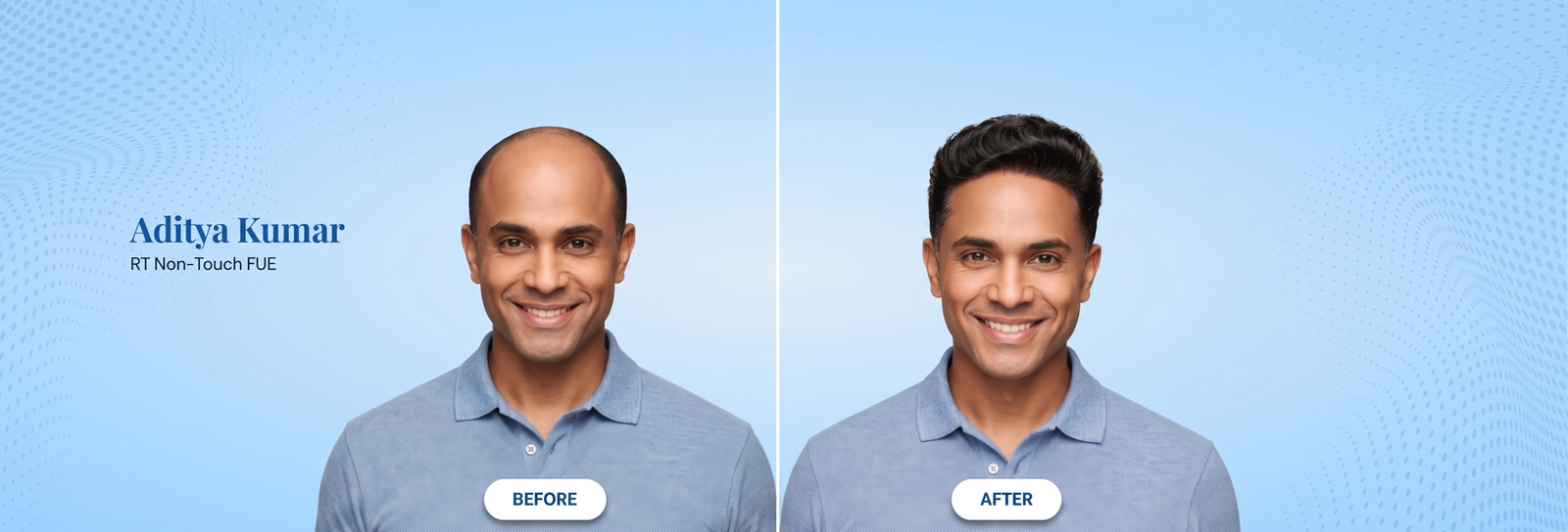 Before & After Hair Transplant